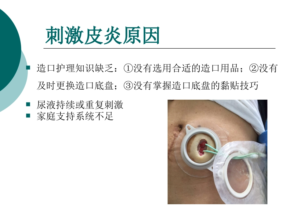 一例输尿管皮肤造口并发刺激性皮炎患者的护理_第6页