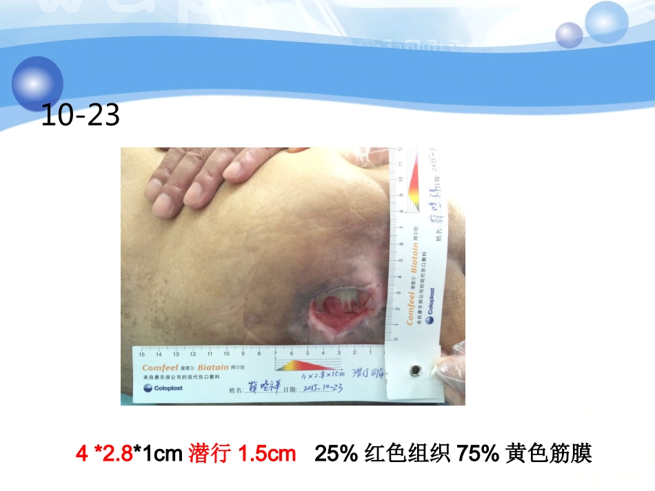 一例糖尿病合并骶尾部压疮患者的护理_第13页