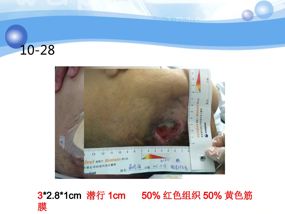 一例糖尿病合并骶尾部压疮患者的护理_第14页