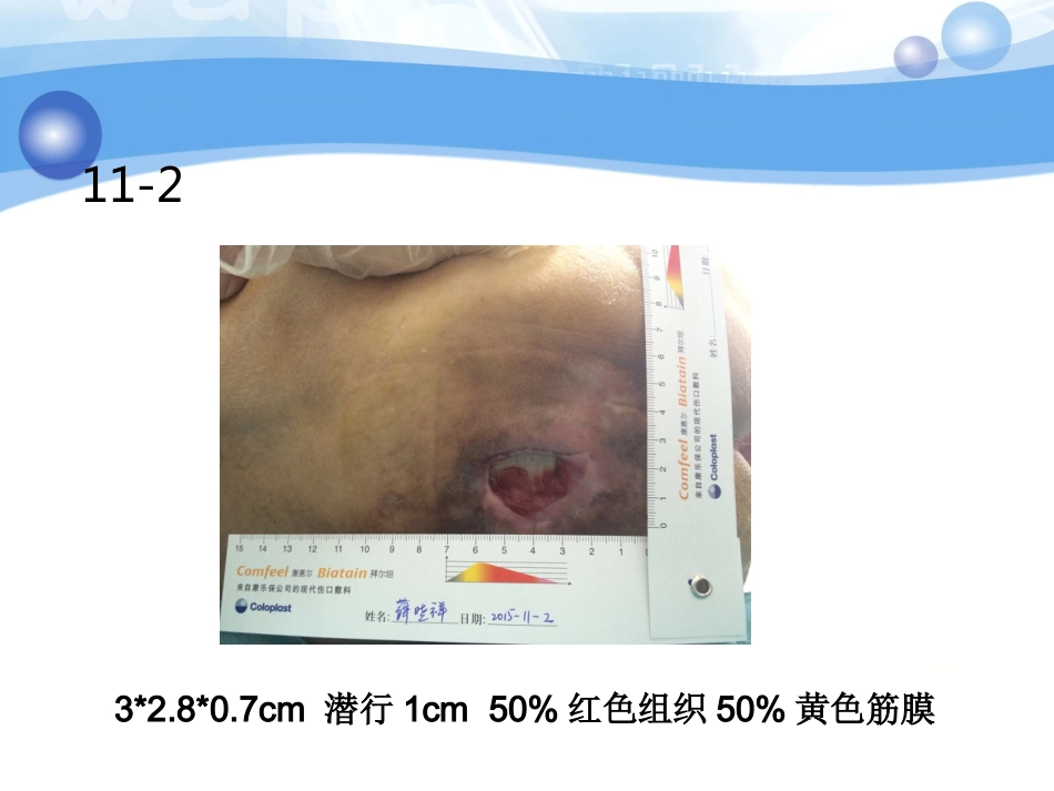 一例糖尿病合并骶尾部压疮患者的护理_第15页