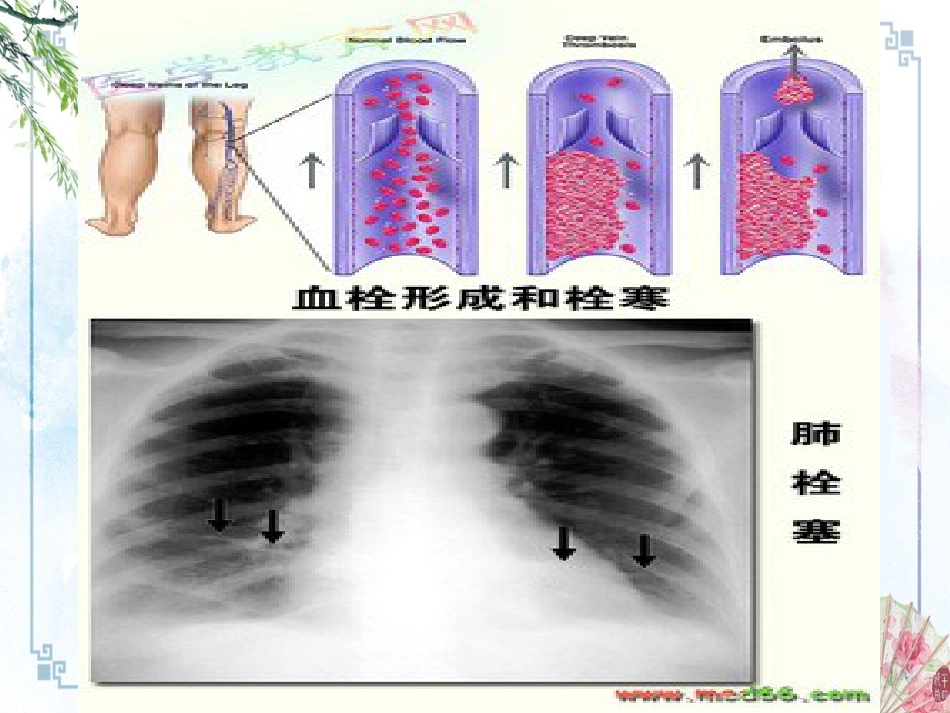 【内科资料】肺栓塞_第9页