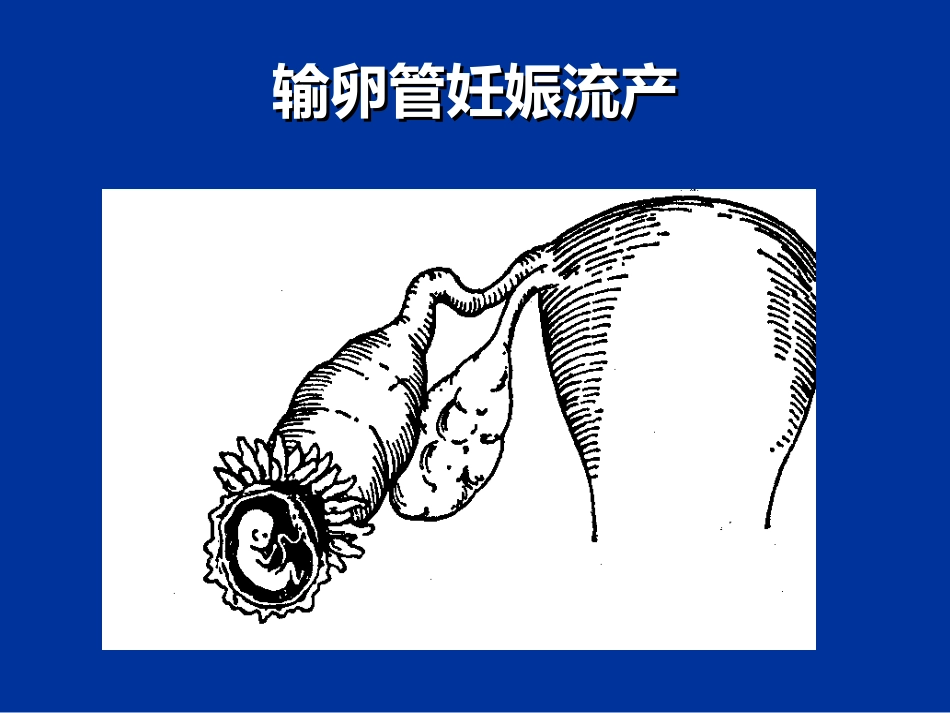 异位妊娠失血性休克的急救与护理_第10页