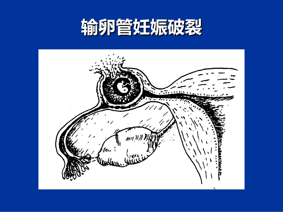 异位妊娠失血性休克的急救与护理_第12页