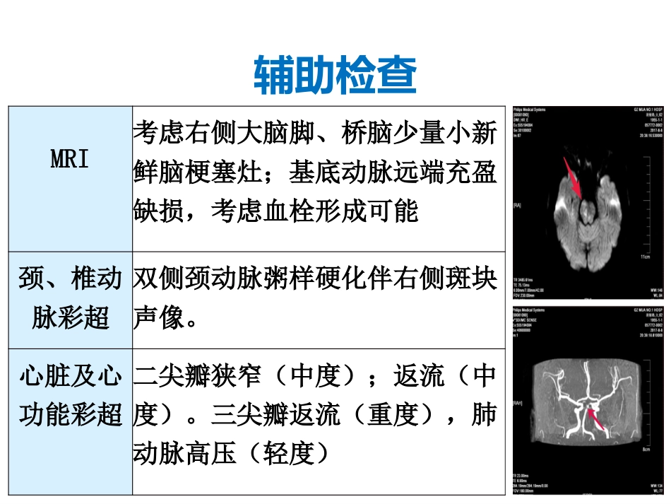 一例脑梗死患者的个性化护理_第11页