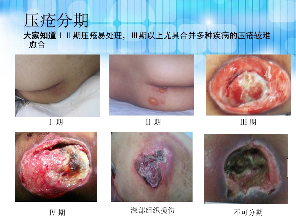 重度压疮个案护理查房_第5页