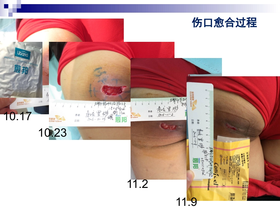 一例臀部巨大脓肿切开引流患者的个案护理_第15页
