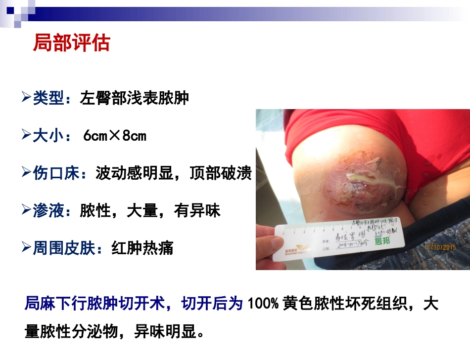 一例臀部巨大脓肿切开引流患者的个案护理_第6页