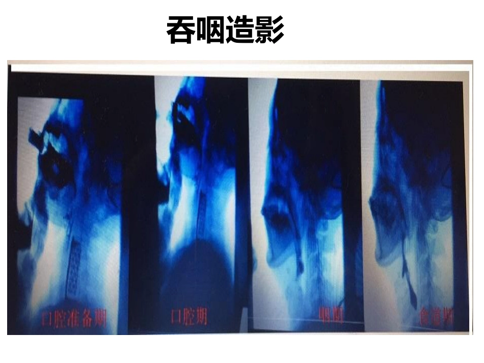 吞咽障碍个案护理_第15页