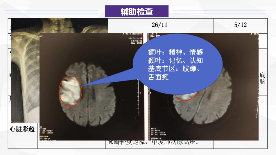 一例大面积急性脑栓塞伴风湿性心脏病患者的康复护理_第10页