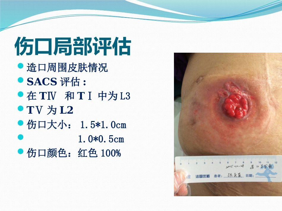 一例回肠造口周围皮肤并发症患者护理_第10页