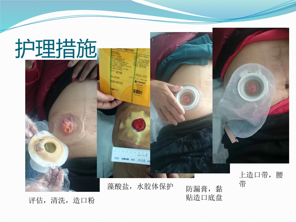 一例回肠造口周围皮肤并发症患者护理_第12页