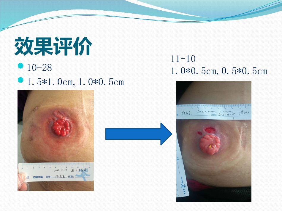 一例回肠造口周围皮肤并发症患者护理_第14页