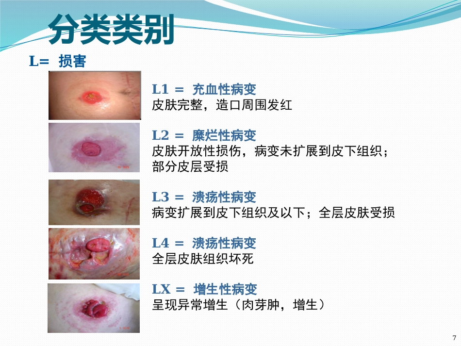 一例回肠造口周围皮肤并发症患者护理_第7页