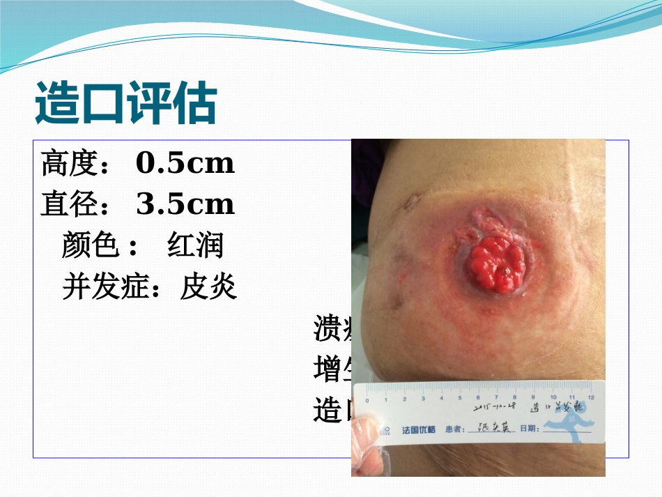 一例回肠造口周围皮肤并发症患者护理_第9页