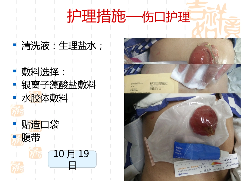 一例横结肠造口术后腹部切口裂开患者的护理_第10页