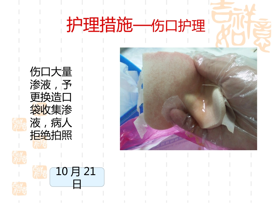 一例横结肠造口术后腹部切口裂开患者的护理_第14页