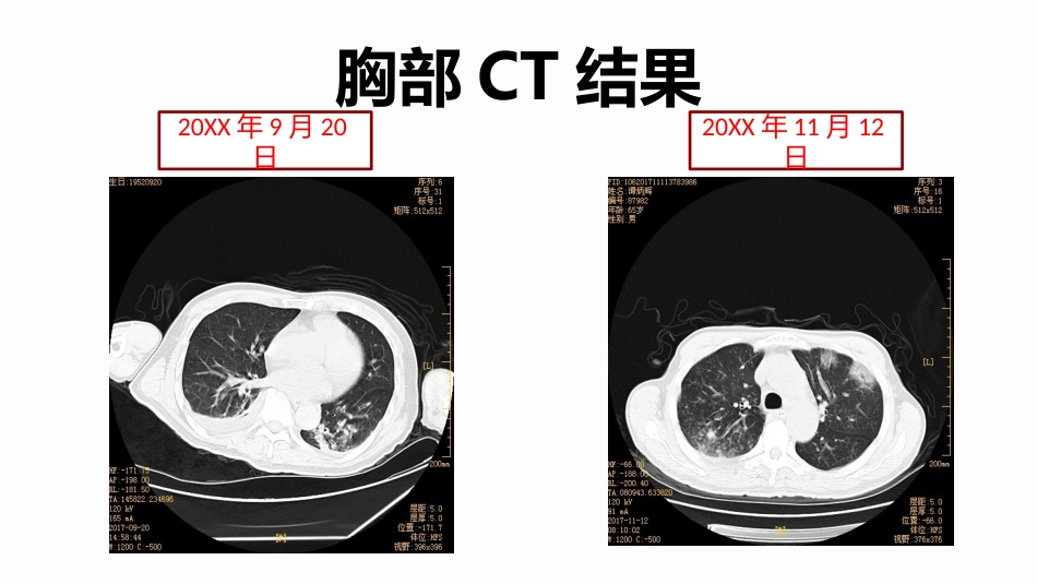 脑梗死合并肺炎个案护理_第11页