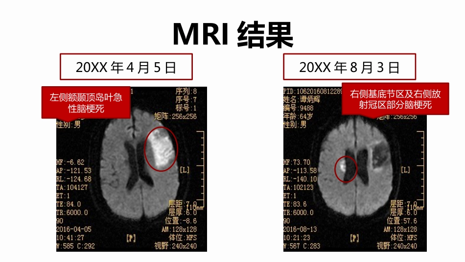 脑梗死合并肺炎个案护理_第12页