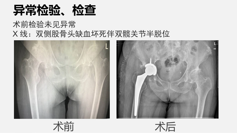 一例全髋关节置换术患者的围手术期护理_第13页