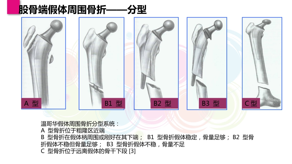 一例股骨假体周围骨折患者的个案护理_第4页
