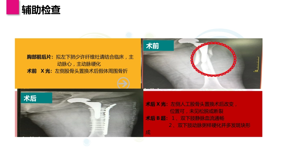 一例股骨假体周围骨折患者的个案护理_第7页