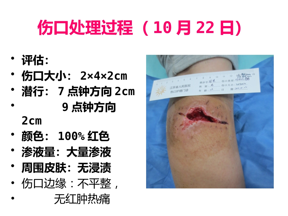 一例缝线伤口延迟愈合患者的护理_第11页