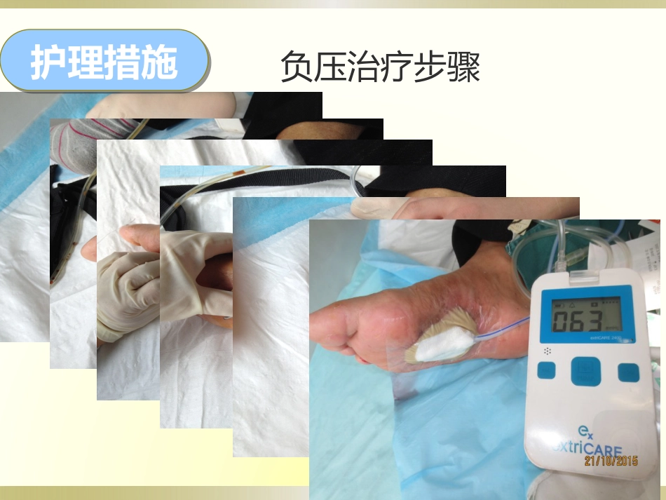 一例糖尿病足感染伴肌腱坏死护理_第15页
