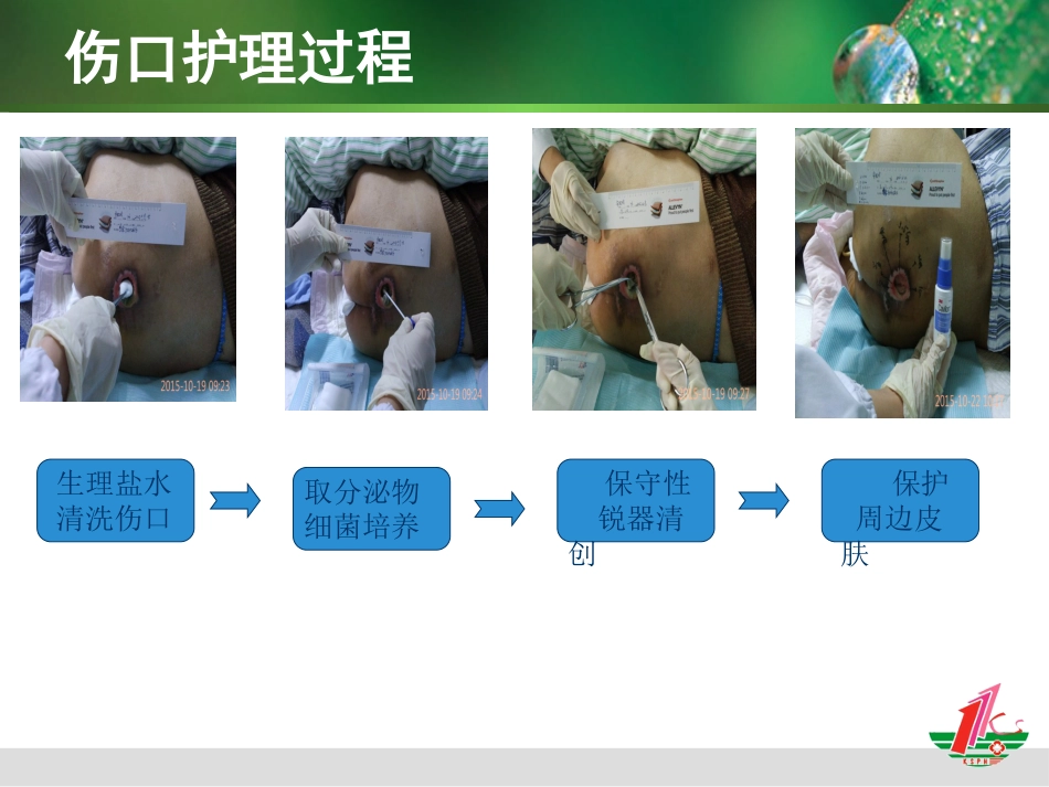 负压治疗一例合并感染Ⅳ期压疮患者的护理体会_第10页