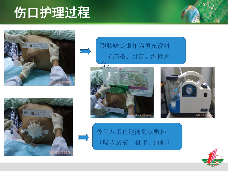 负压治疗一例合并感染Ⅳ期压疮患者的护理体会_第11页