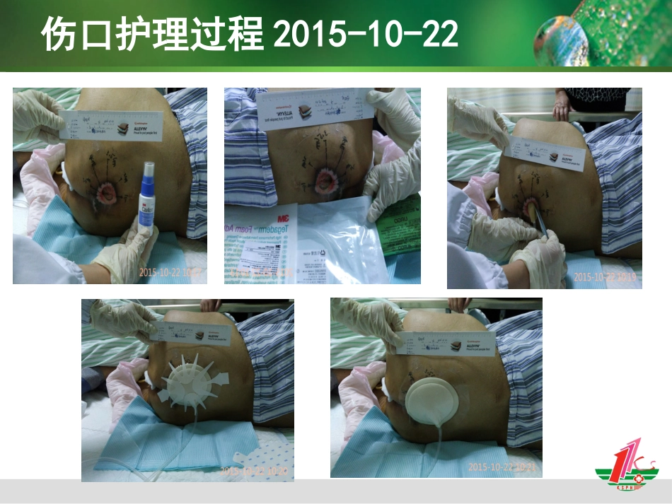 负压治疗一例合并感染Ⅳ期压疮患者的护理体会_第14页