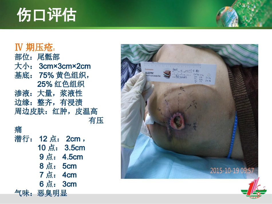 负压治疗一例合并感染Ⅳ期压疮患者的护理体会_第7页