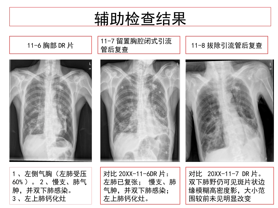 延续护理模式对一例慢性阻塞性肺疾病患者的护理_第12页