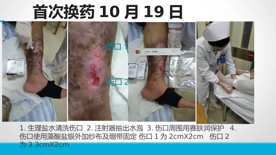下肢静脉溃患者的护理_第10页