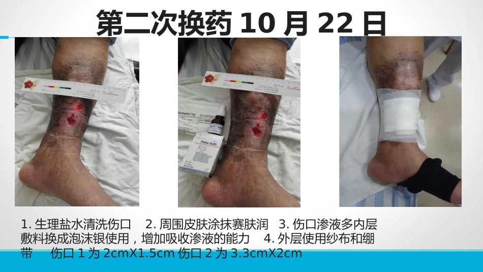 下肢静脉溃患者的护理_第11页