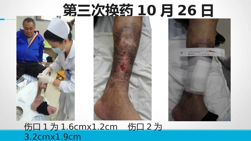 下肢静脉溃患者的护理_第12页