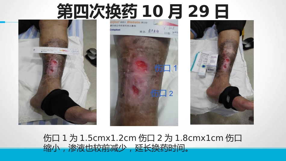 下肢静脉溃患者的护理_第13页