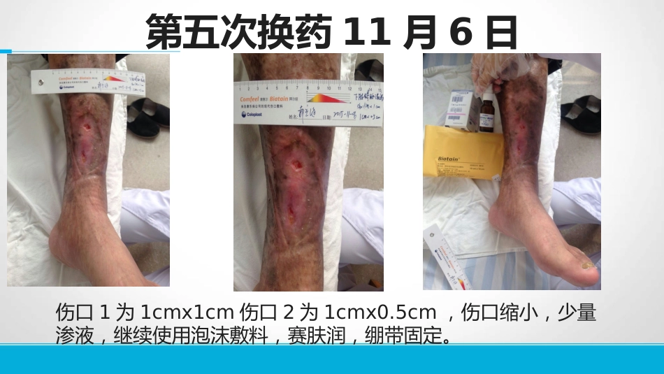 下肢静脉溃患者的护理_第14页