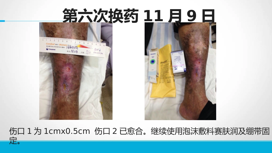 下肢静脉溃患者的护理_第15页