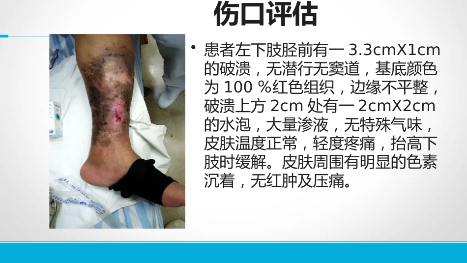 下肢静脉溃患者的护理_第7页