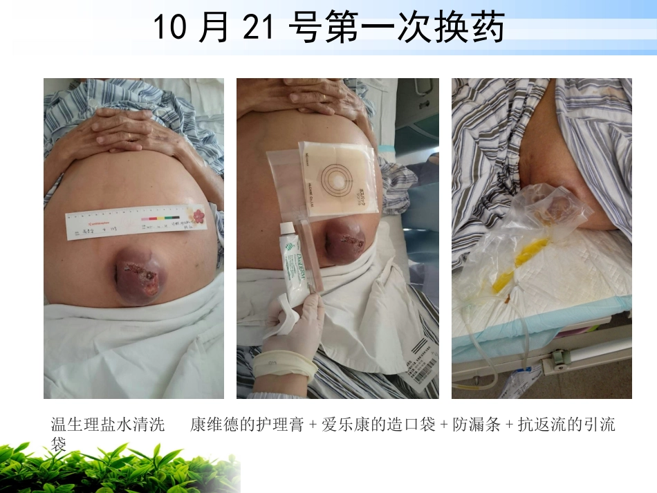 一例肝硬化腹水伴脐疝破溃患者的护理_第11页