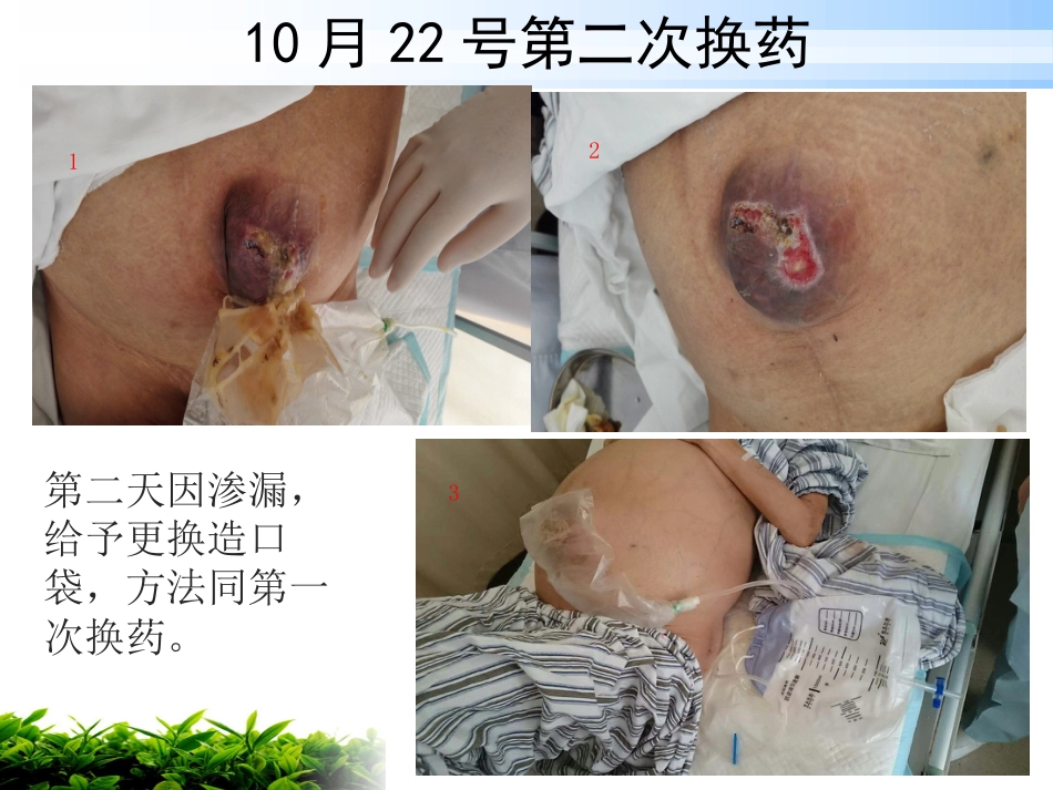 一例肝硬化腹水伴脐疝破溃患者的护理_第12页