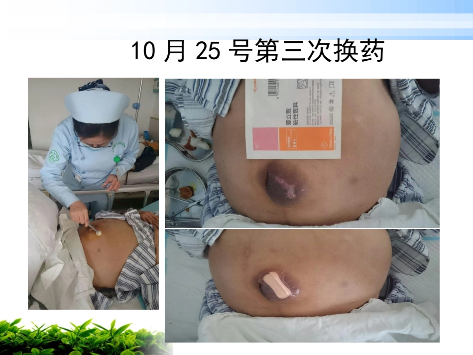 一例肝硬化腹水伴脐疝破溃患者的护理_第13页