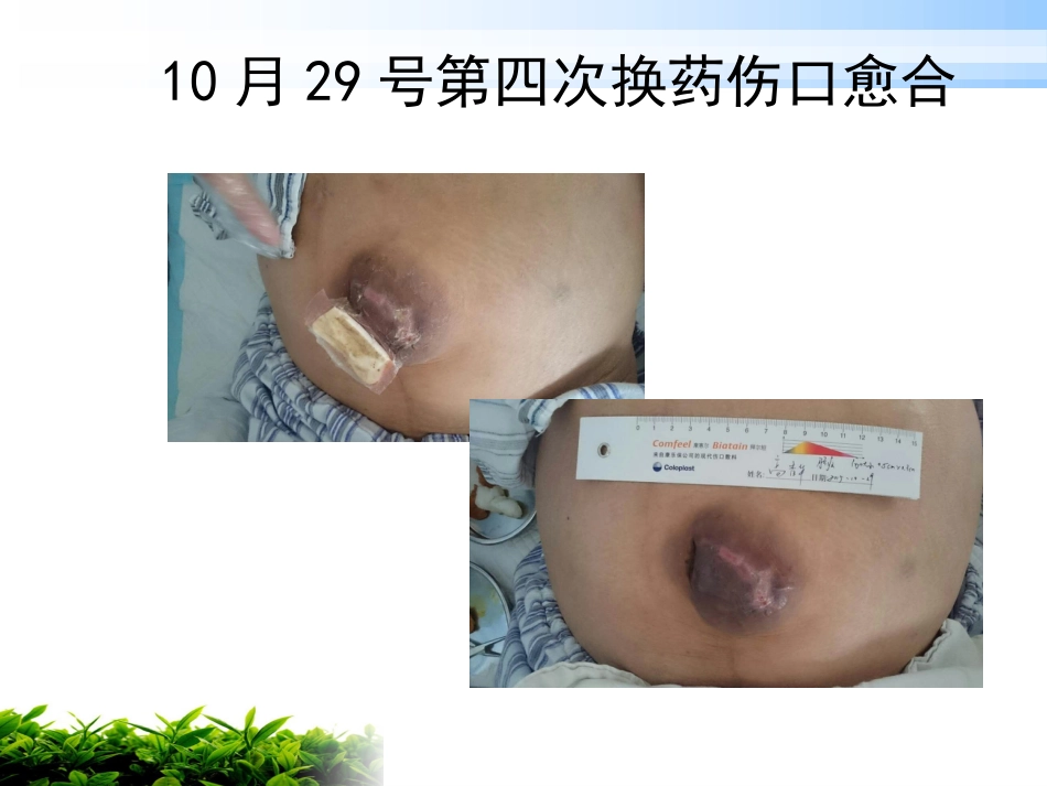 一例肝硬化腹水伴脐疝破溃患者的护理_第14页