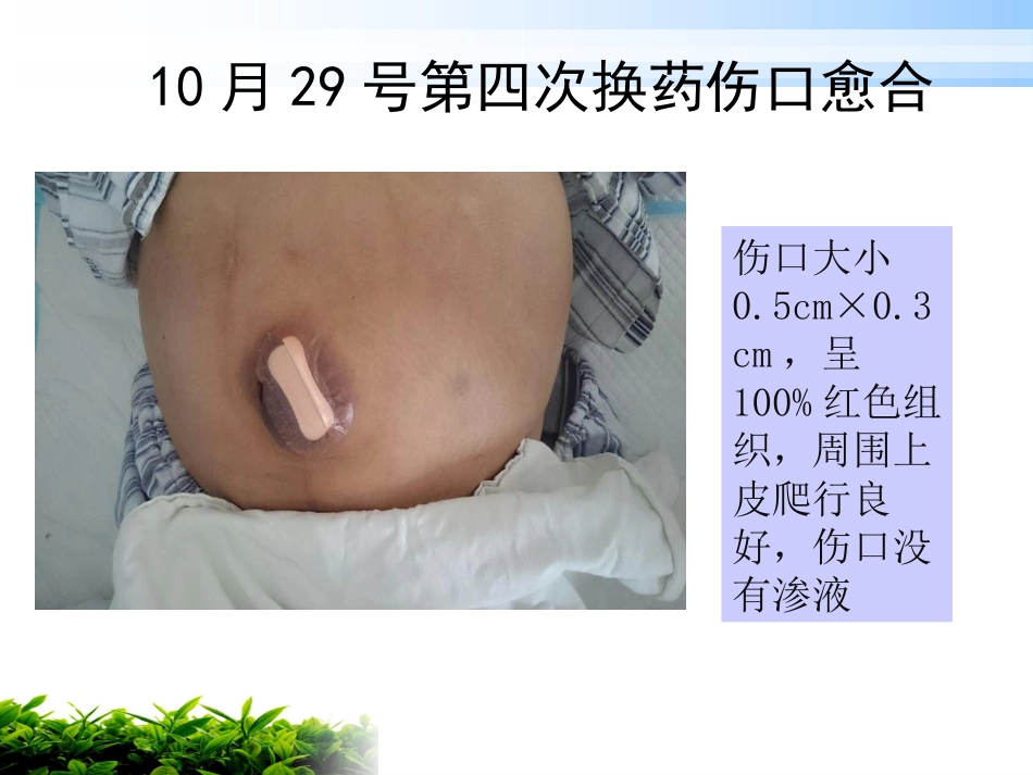 一例肝硬化腹水伴脐疝破溃患者的护理_第15页