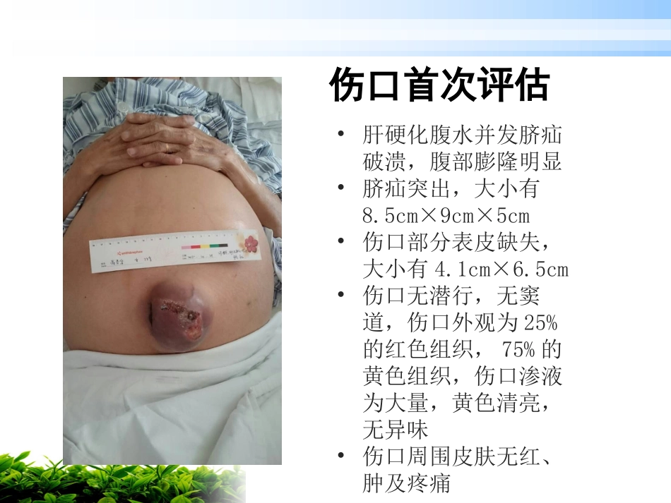 一例肝硬化腹水伴脐疝破溃患者的护理_第7页