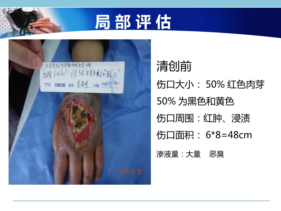 一例化疗药物外渗局部组织溃疡坏死患者的个案护理_第10页