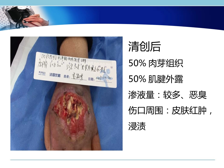 一例化疗药物外渗局部组织溃疡坏死患者的个案护理_第14页