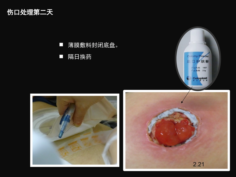 结肠肠造口术后皮肤黏膜分离个案护理_第10页