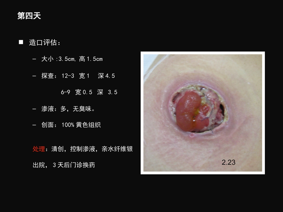 结肠肠造口术后皮肤黏膜分离个案护理_第11页