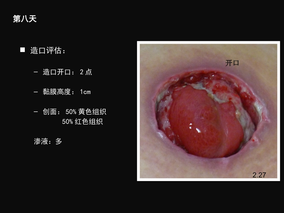 结肠肠造口术后皮肤黏膜分离个案护理_第12页